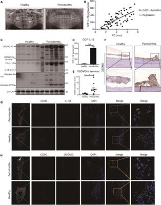 Periodontal Inflammation-Triggered by Periodontal Ligament Stem Cell Pyroptosis Exacerbates Periodontitis